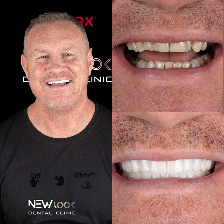 turkey teeth packages